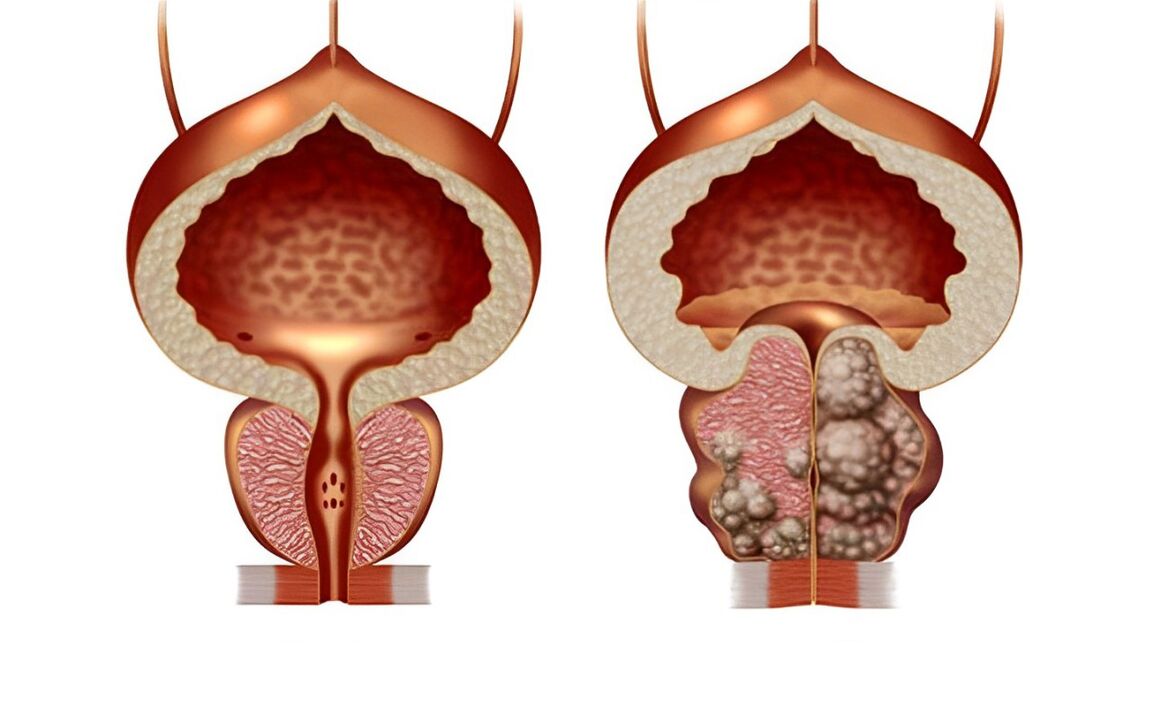 Como é un adenoma de próstata 