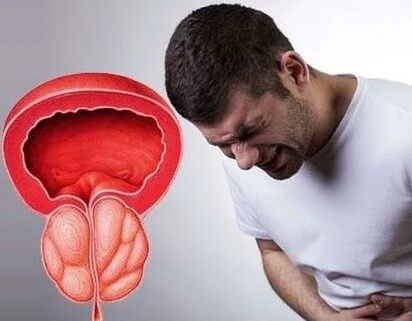 Síntomas da prostatite crónica nos homes